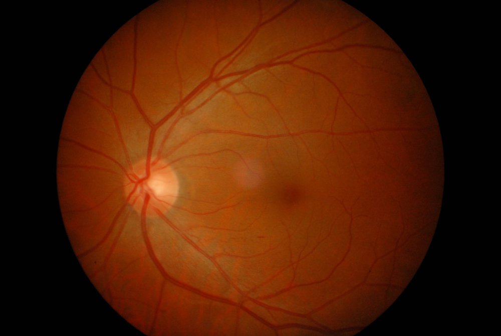 pucker maculare oftalmologia